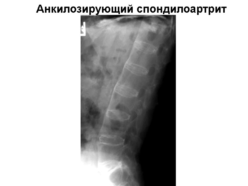 Анкилозирующий спондилоартрит